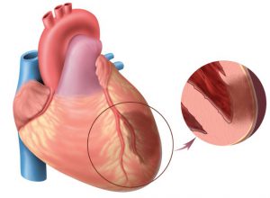 Rupture of heart tissue