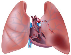 Blockage of the pulmonary arteries