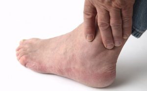 Ankle swelling