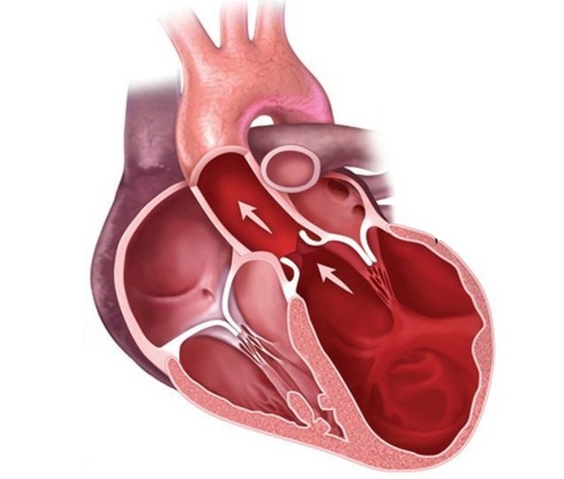 Желудочка сердца расширена. Ишемическая кардиомиопатия. Гипертрофия и дилатация сердца. Дилатация левого желудочка. Ишемия левого желудочка сердца.