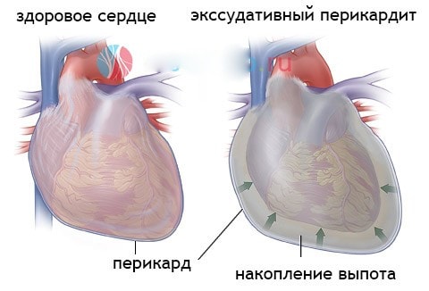 Здоровое сердце и перикардит 