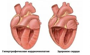 Sick and healthy heart 