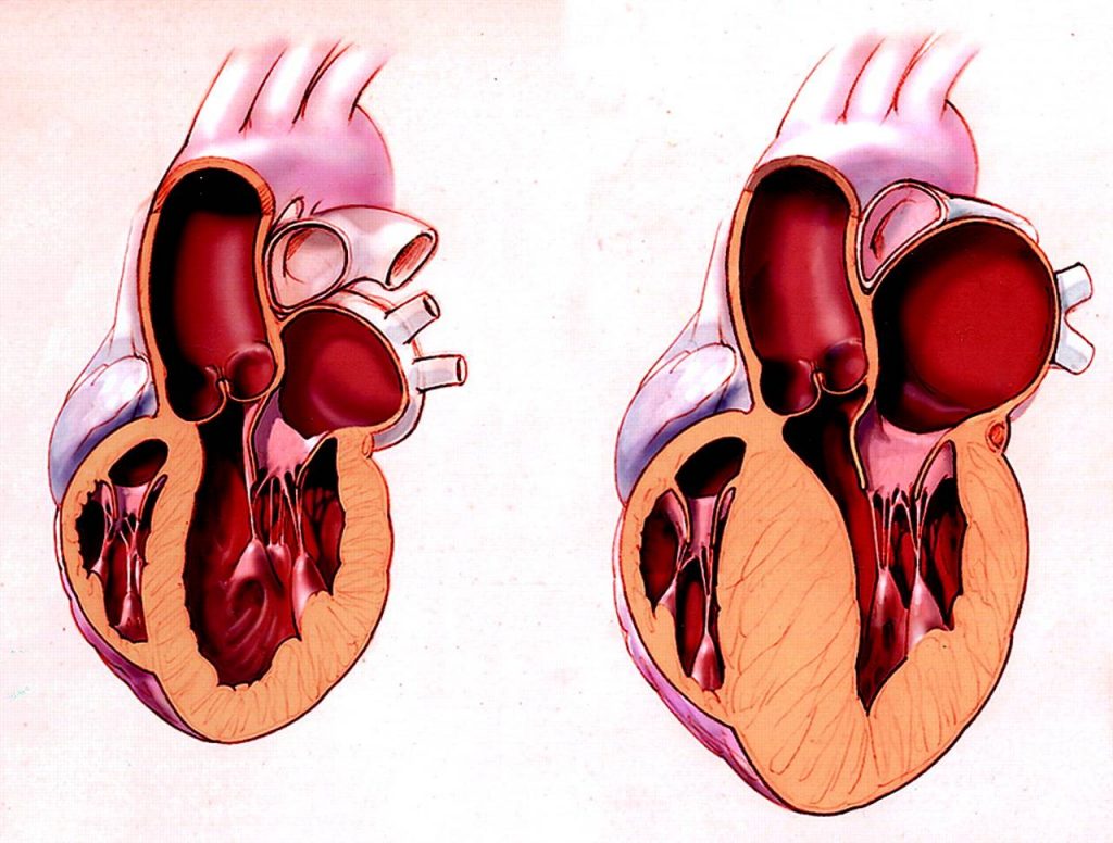 Как проявляется и диагностируется дилатационная и другие виды кардиомиопатии