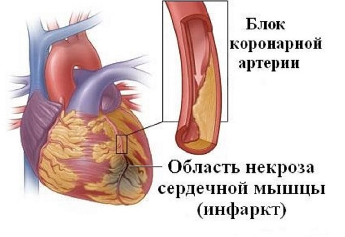 Некроз тканей при инфаркте
